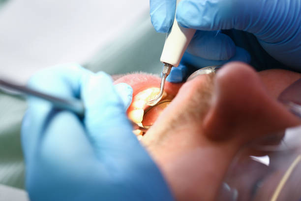 Best Emergency Wisdom Teeth Removal in Story City, IA